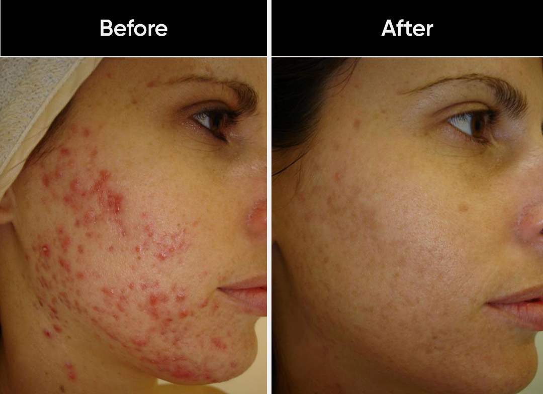 Cystic Acne Treatment That Works: A Comprehensive Guide