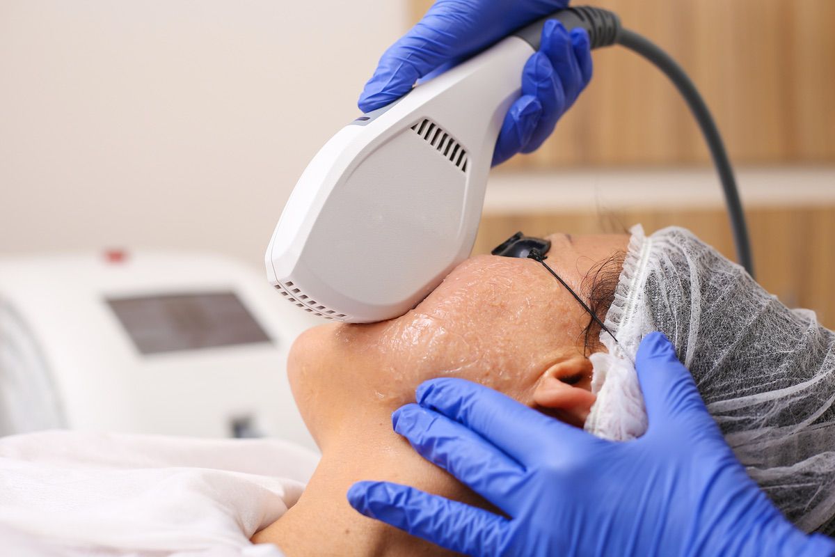 Photofacial IPL Treatment San Antonio Stadia Treatment Image B