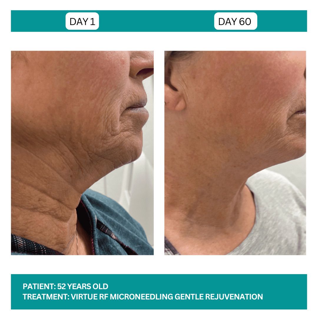 Virtue RF before and After - 1