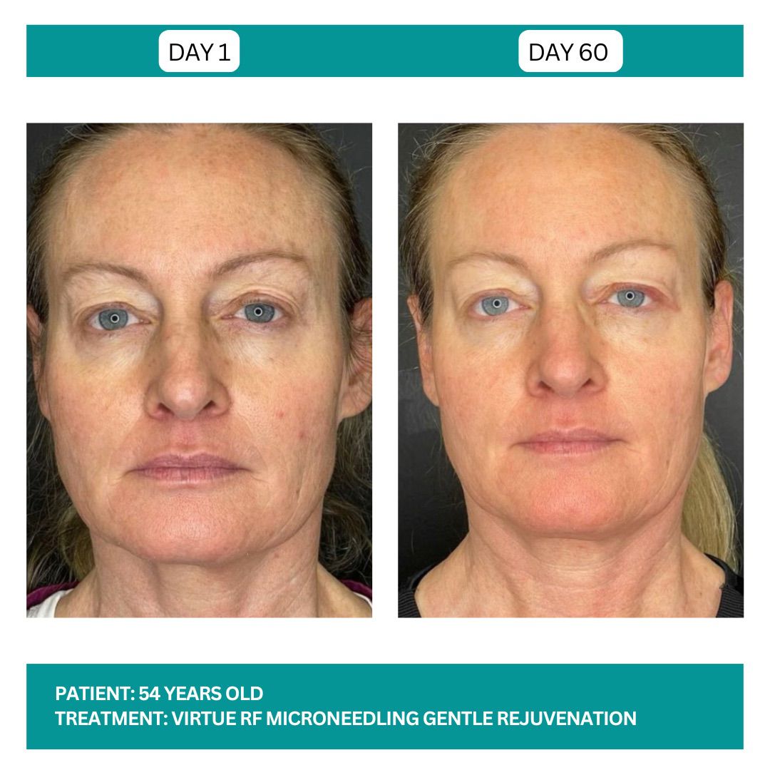 Virtue RF before and After - 2