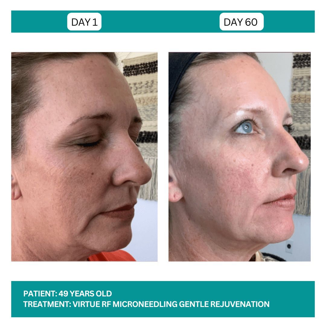 Virtue RF before and After - 3