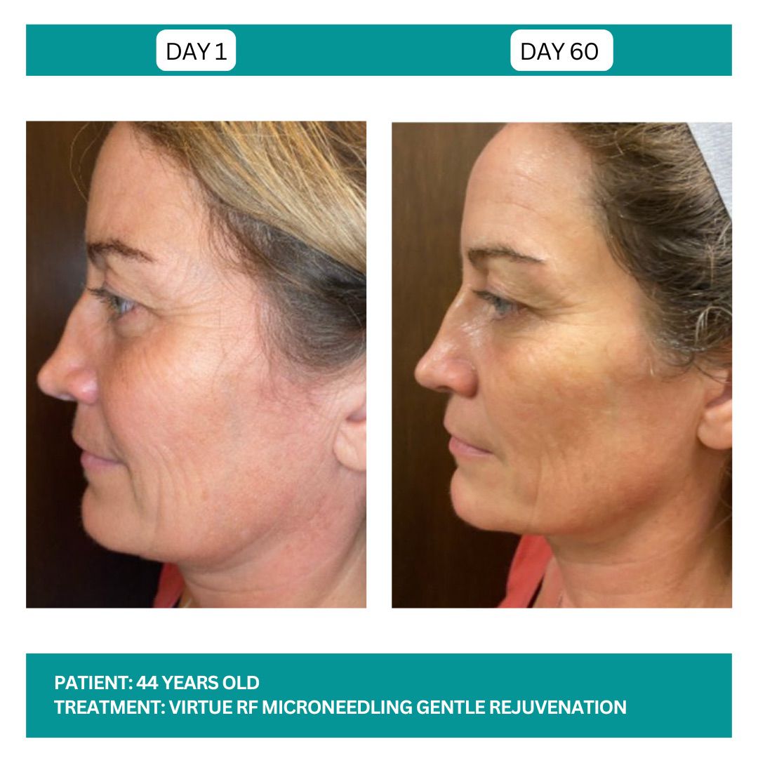 Virtue RF before and After - 4
