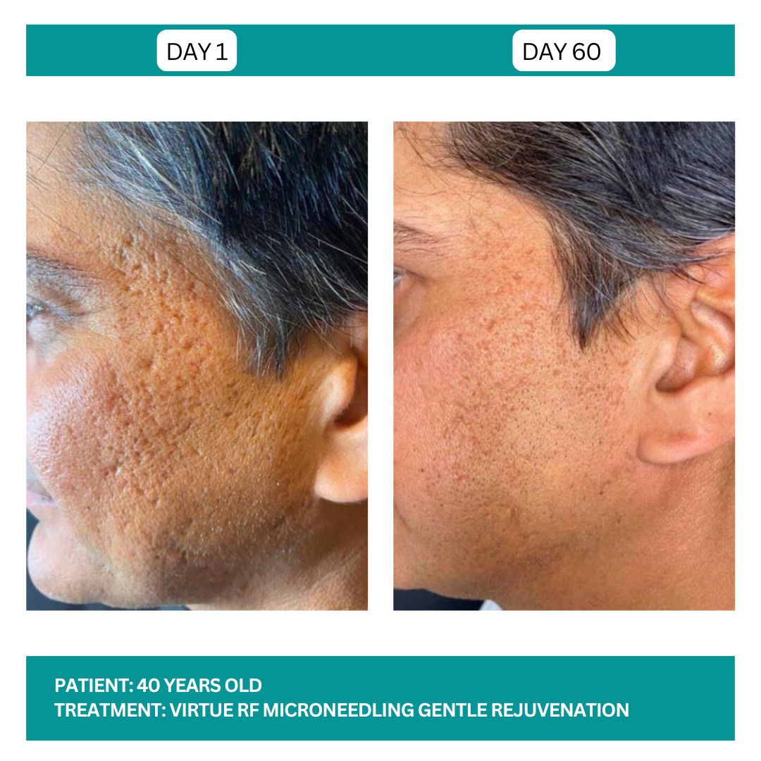 Virtue RF before and After - 5