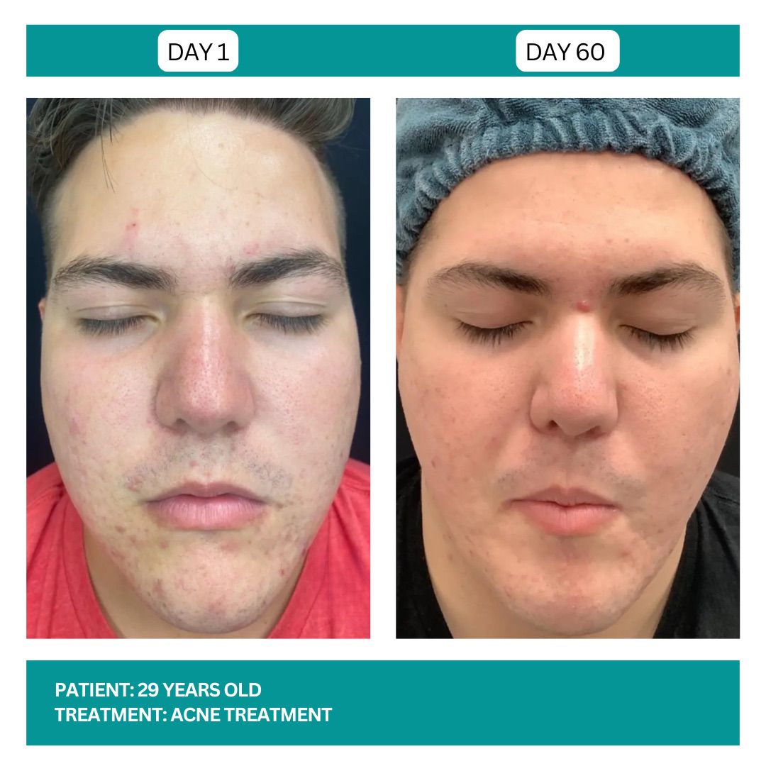 ACNE TREATMENT BEFORE AND AFTER - 4