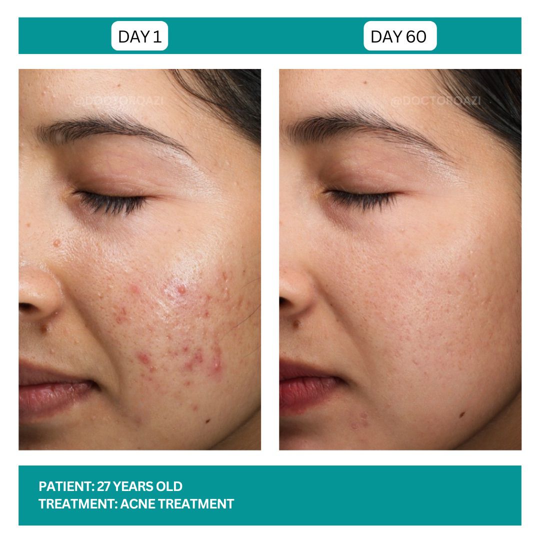ACNE TREATMENT BEFORE AND AFTER - 5