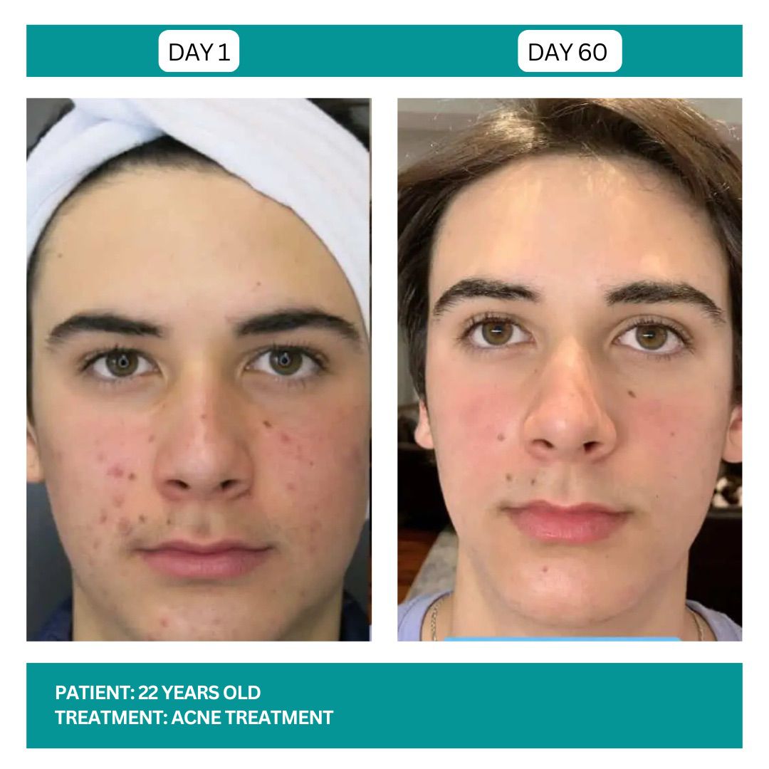 ACNE TREATMENT BEFORE AND AFTER - 2