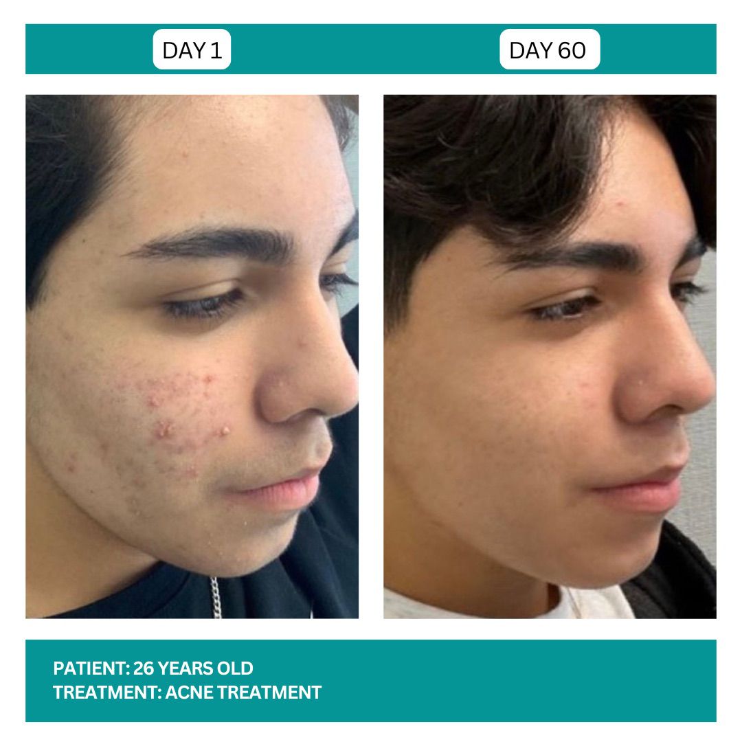 ACNE TREATMENT BEFORE AND AFTER - 3
