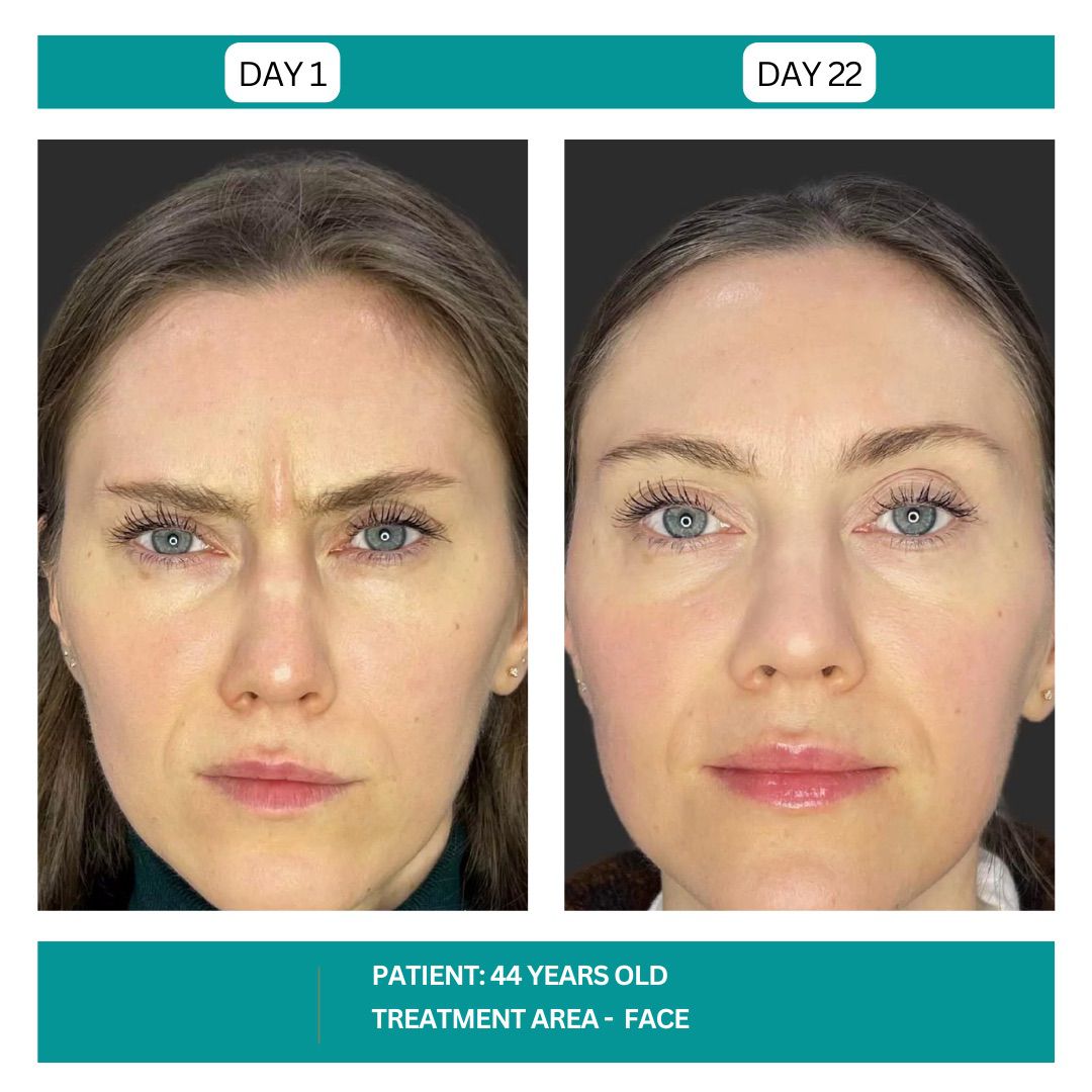 STADIA BOTOX BEFORE AND AFTER - 20