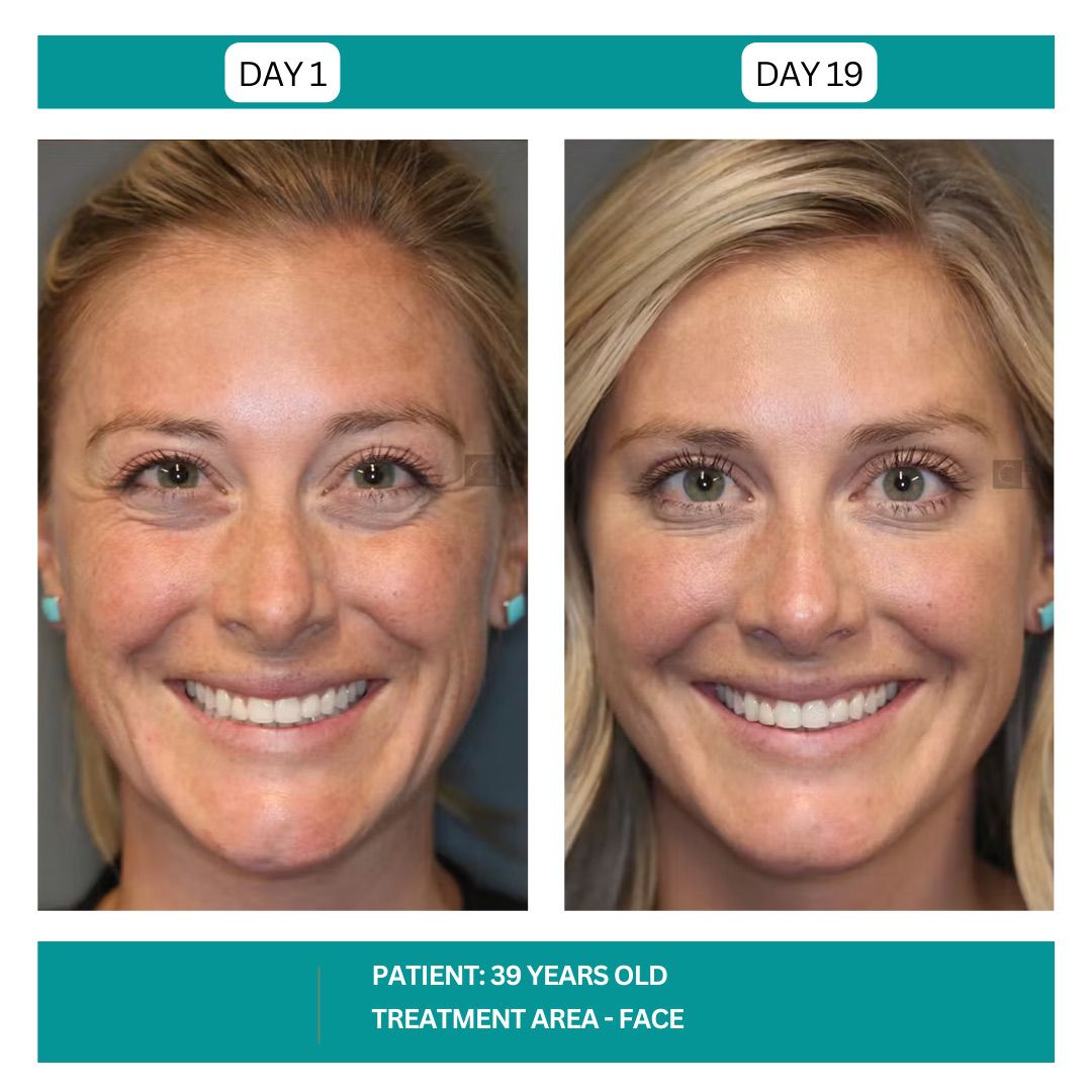 STADIA BOTOX BEFORE AND AFTER - 18
