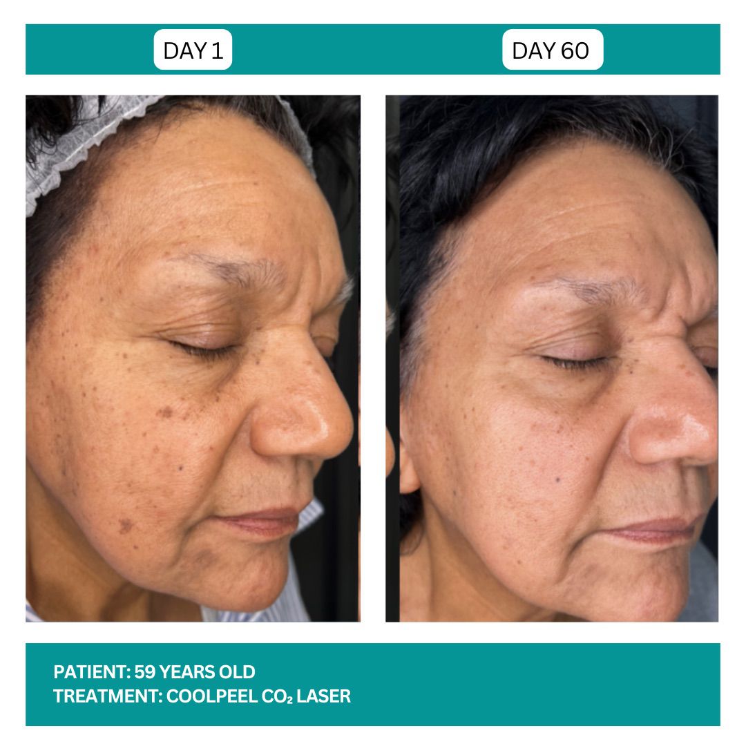 COOLPEEL BEFORE AND AFTER - 4