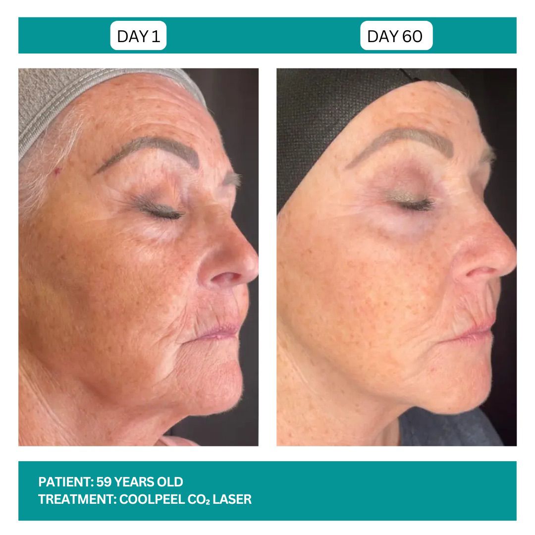 COOLPEEL BEFORE AND AFTER - 5
