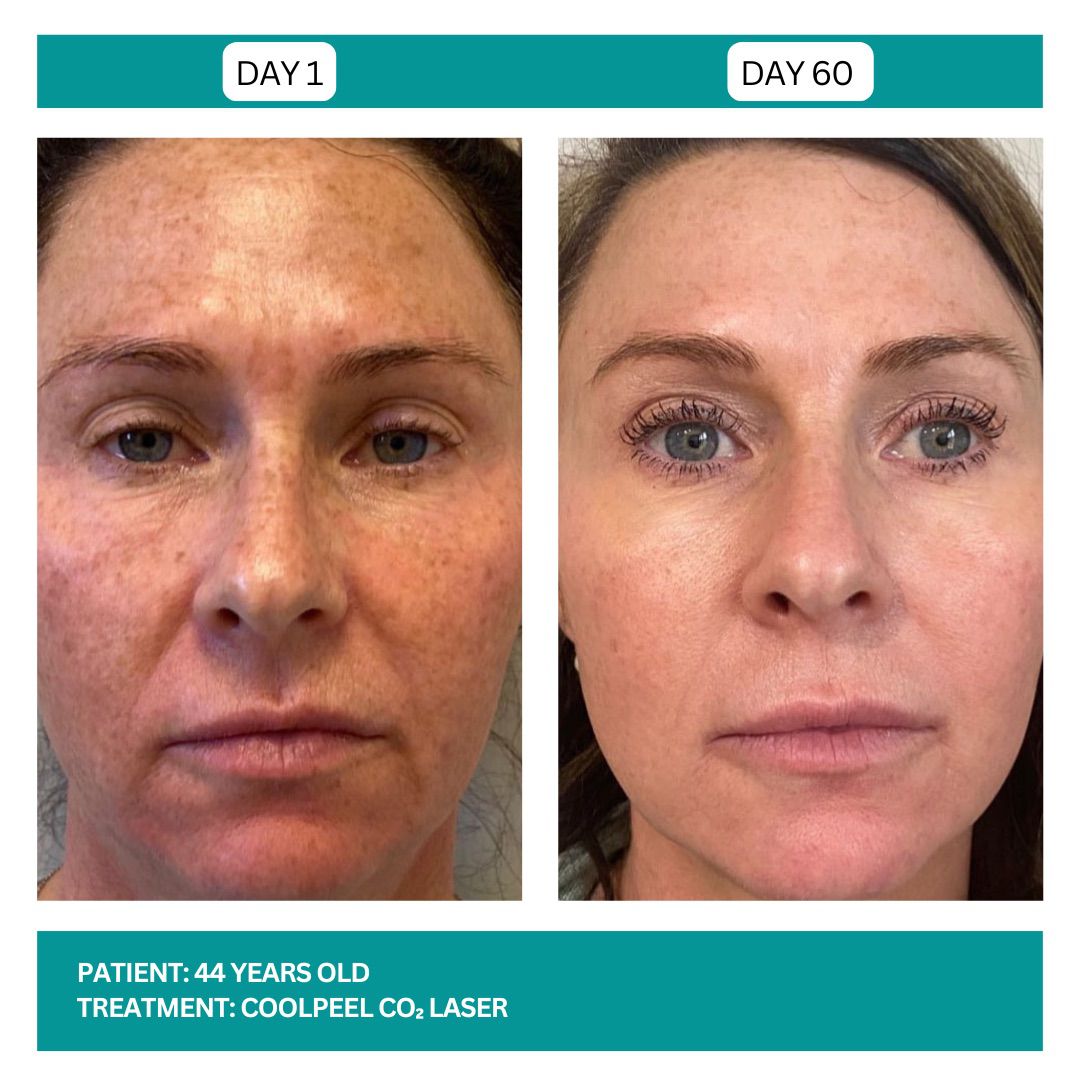 COOLPEEL BEFORE AND AFTER - 2