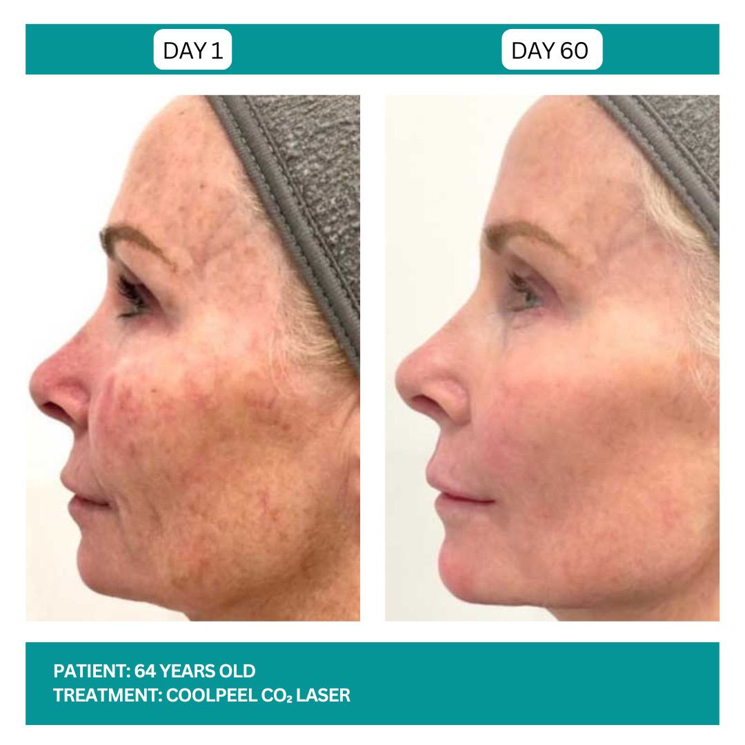 COOLPEEL BEFORE AND AFTER - 3