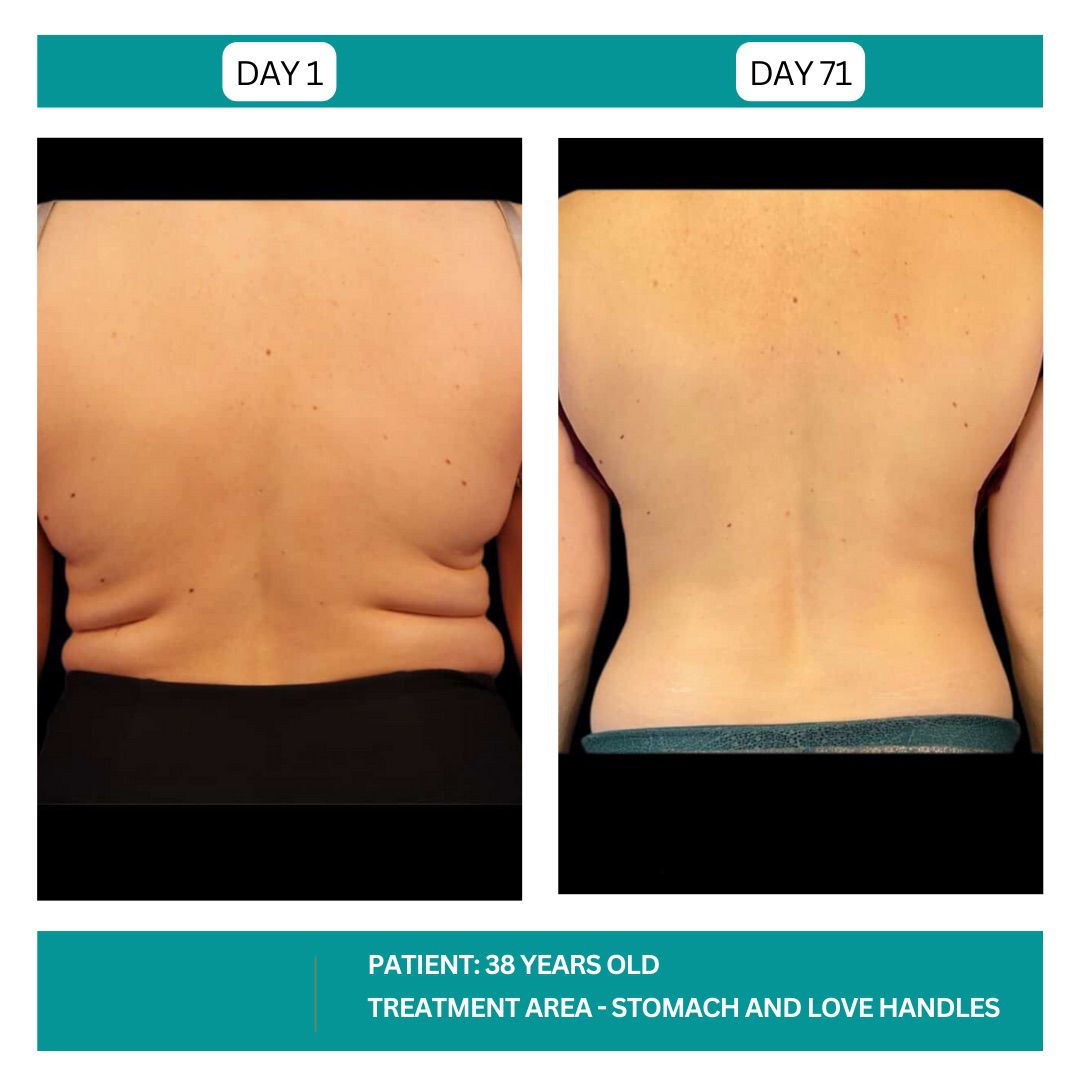 STADIA COOLSCULPTING BEFORE AND AFTER - 4