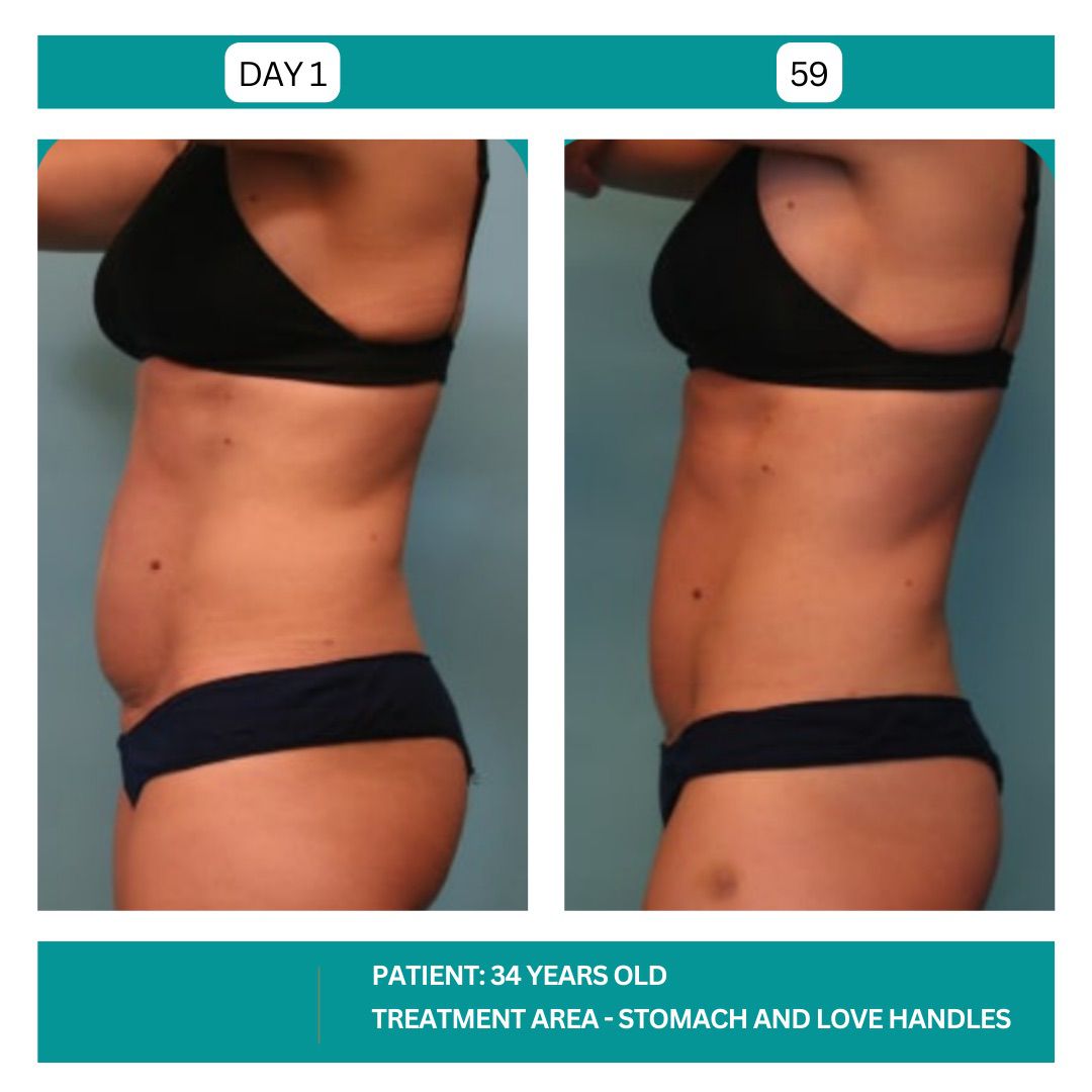 STADIA COOLSCULPTING BEFORE AND AFTER - 5