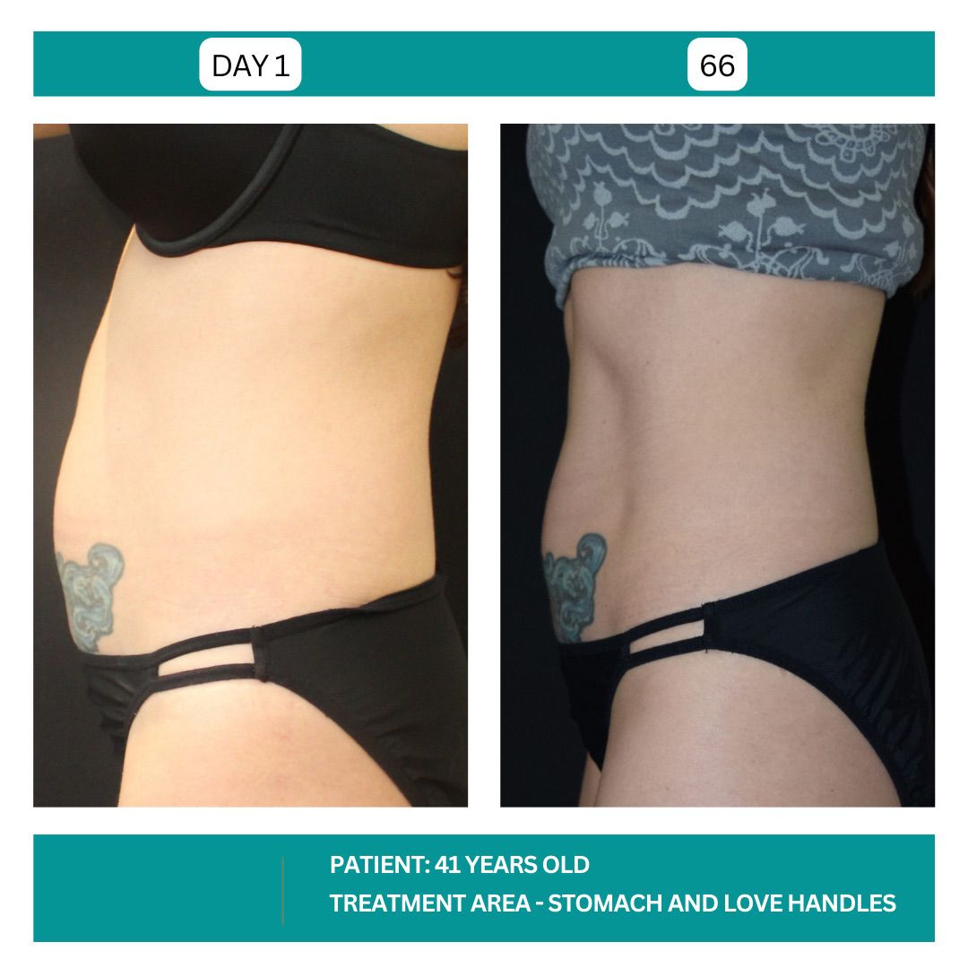 STADIA COOLSCULPTING BEFORE AND AFTER - 7