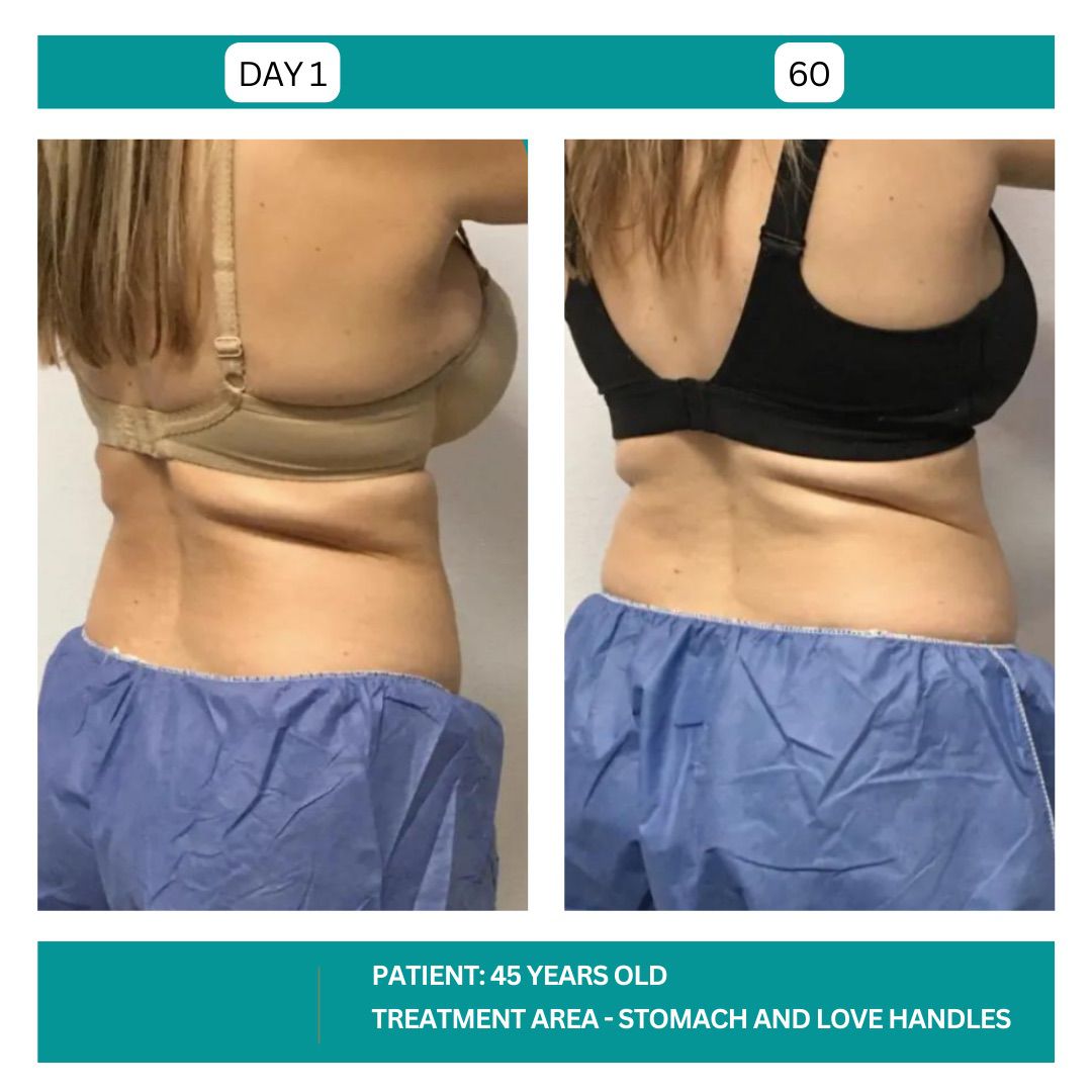 STADIA COOLSCULPTING BEFORE AND AFTER - 6