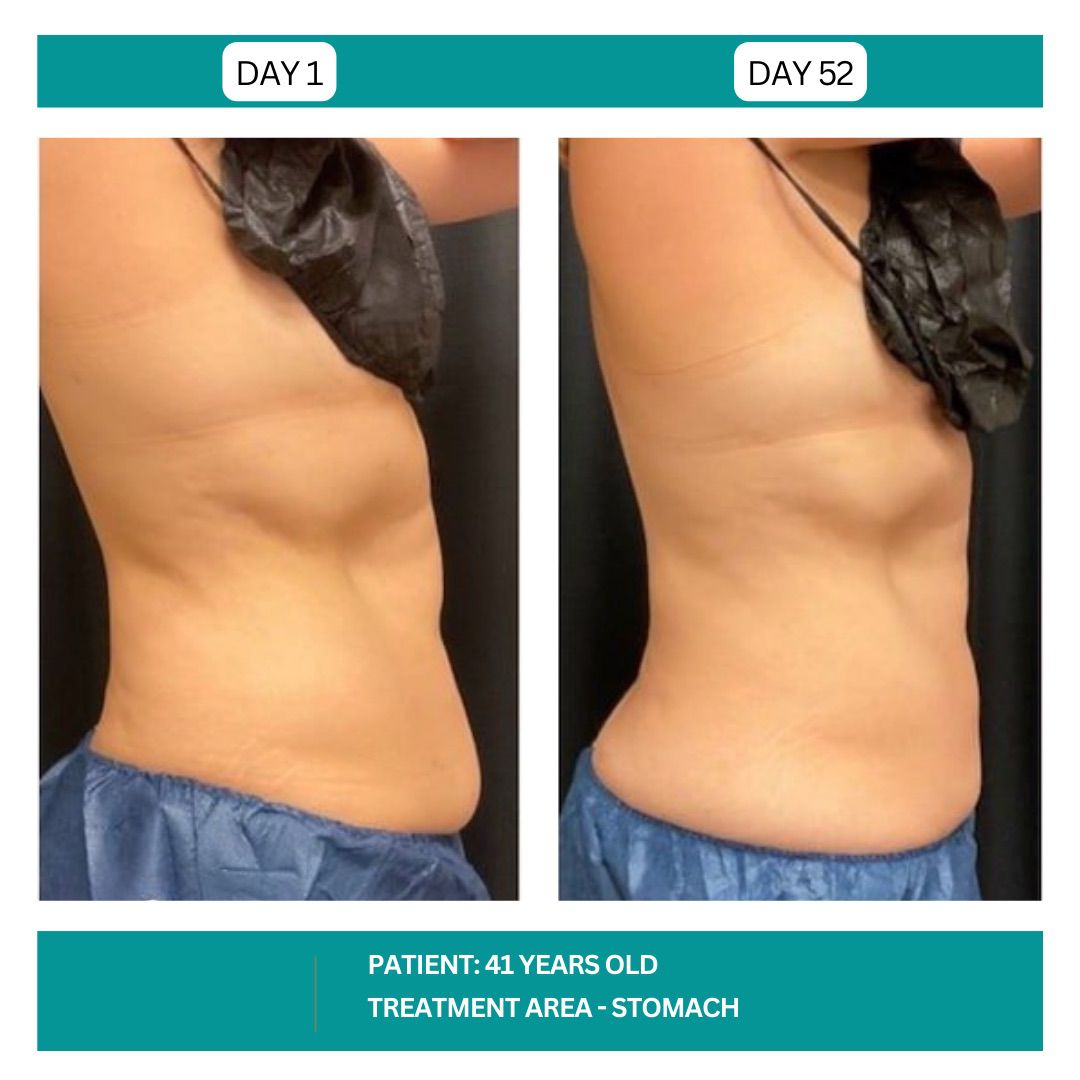 STADIA COOLSCULPTING BEFORE AND AFTER - 2