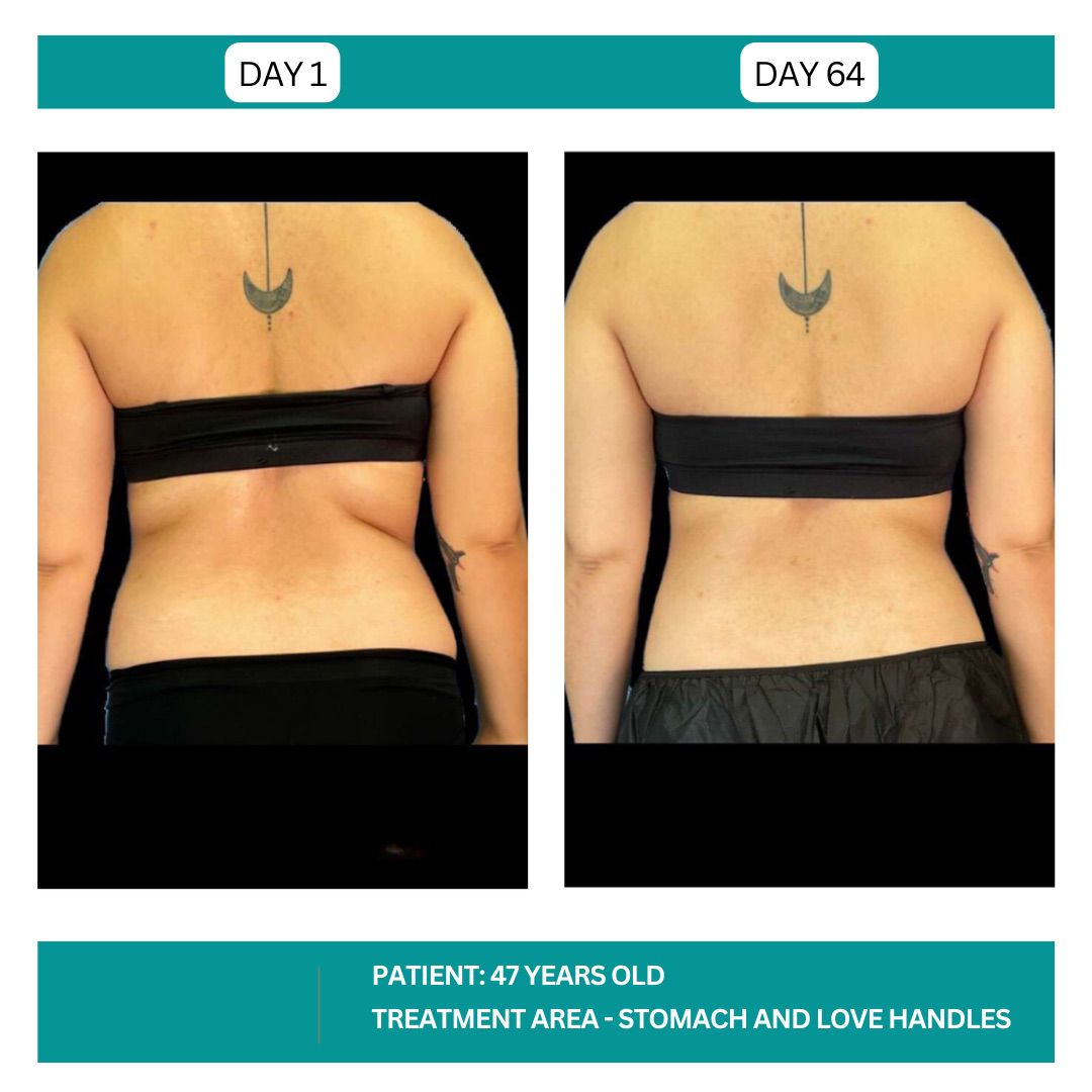 STADIA COOLSCULPTING BEFORE AND AFTER - 3