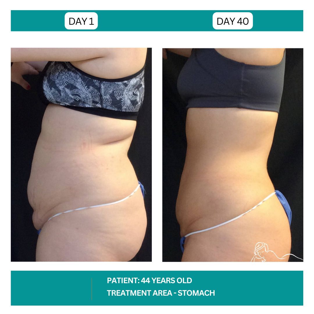 STADIA COOLSCULPTING BEFORE AND AFTER - 1