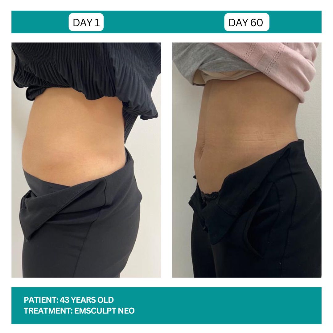 EMSCULPT NEO BEFORE AND AFTER - 4