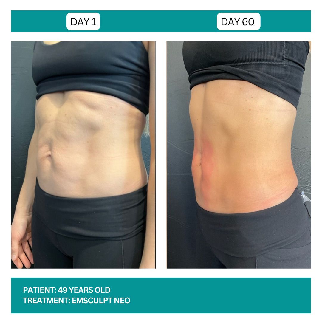 EMSCULPT NEO BEFORE AND AFTER - 5