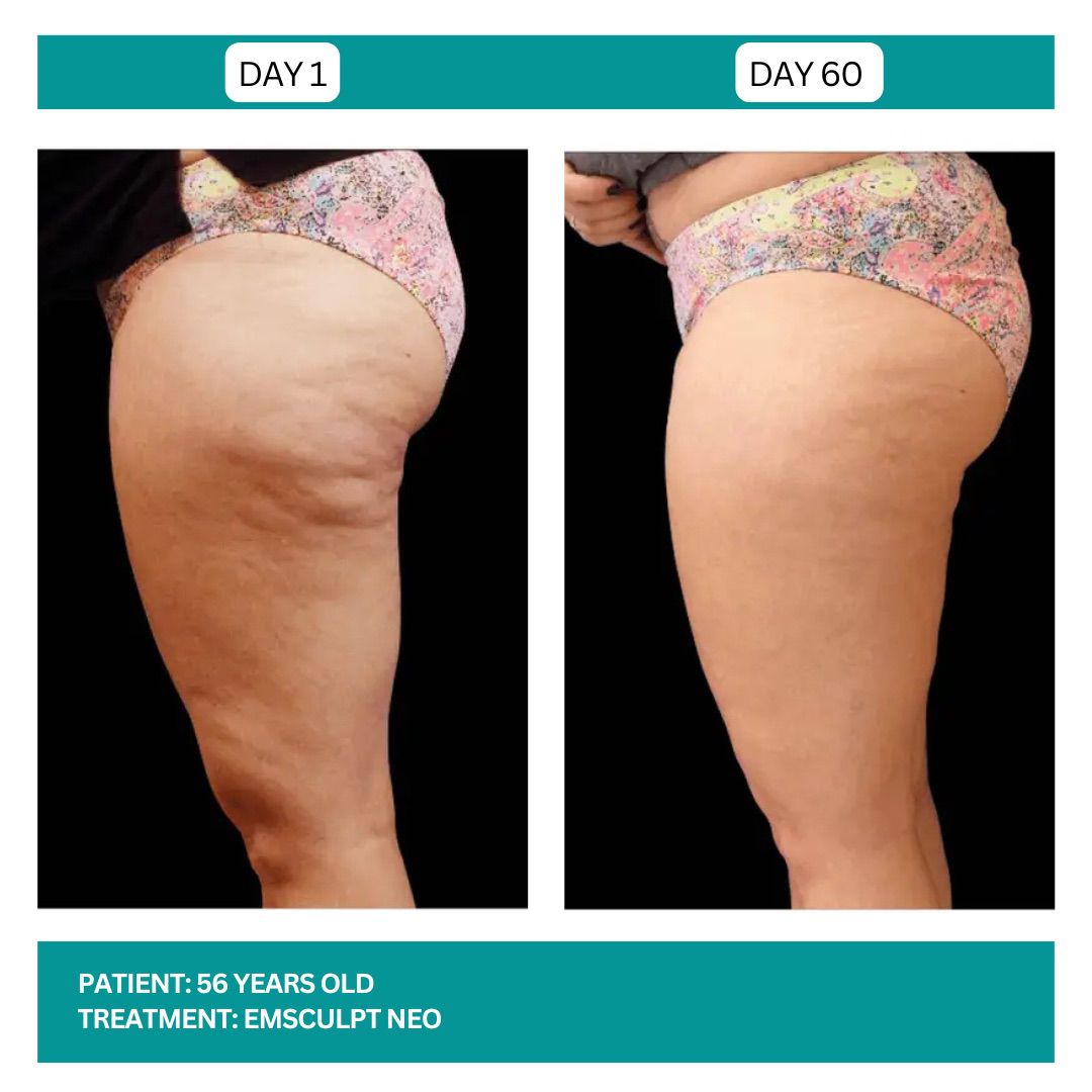EMSCULPT NEO BEFORE AND AFTER - 6