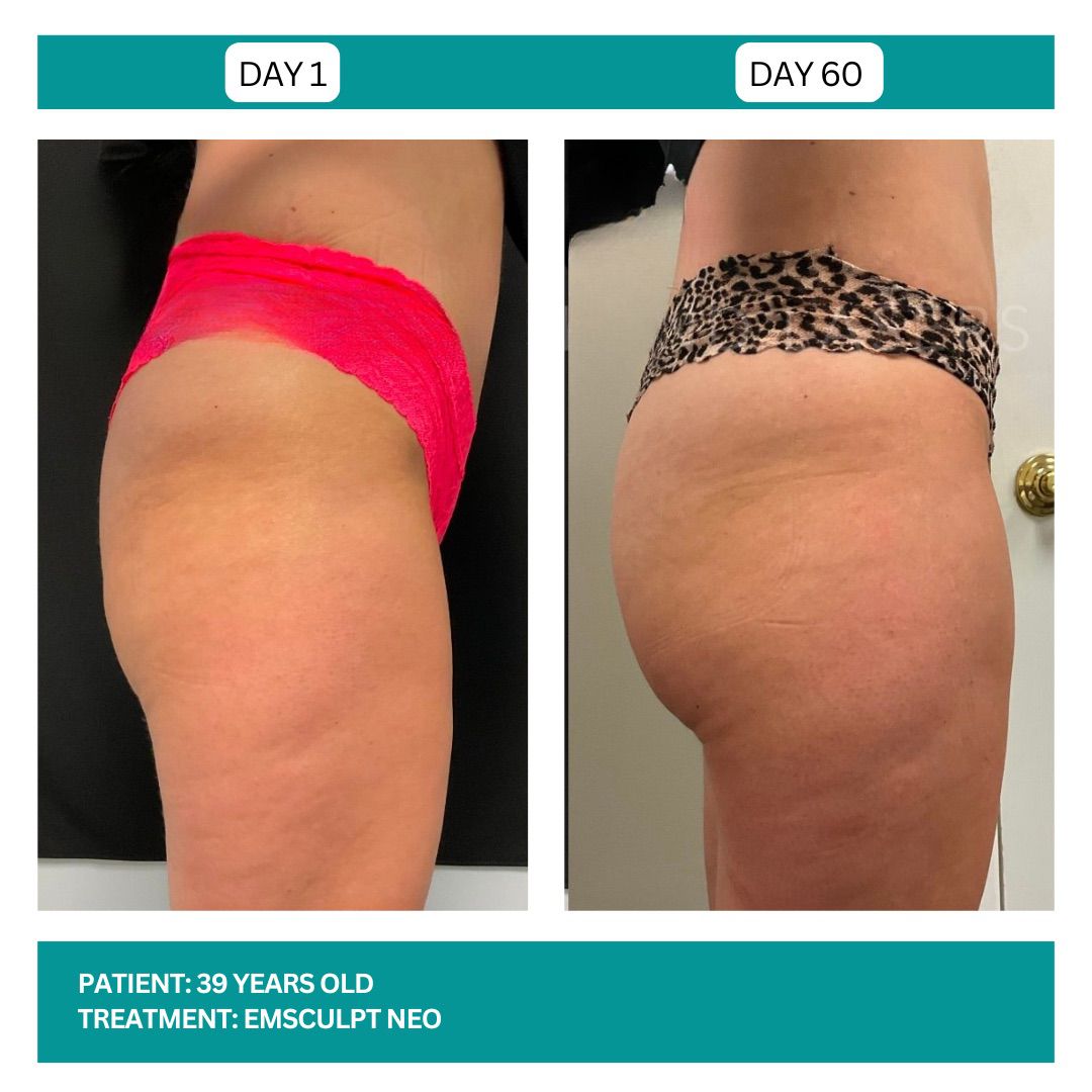 EMSCULPT NEO BEFORE AND AFTER - 2