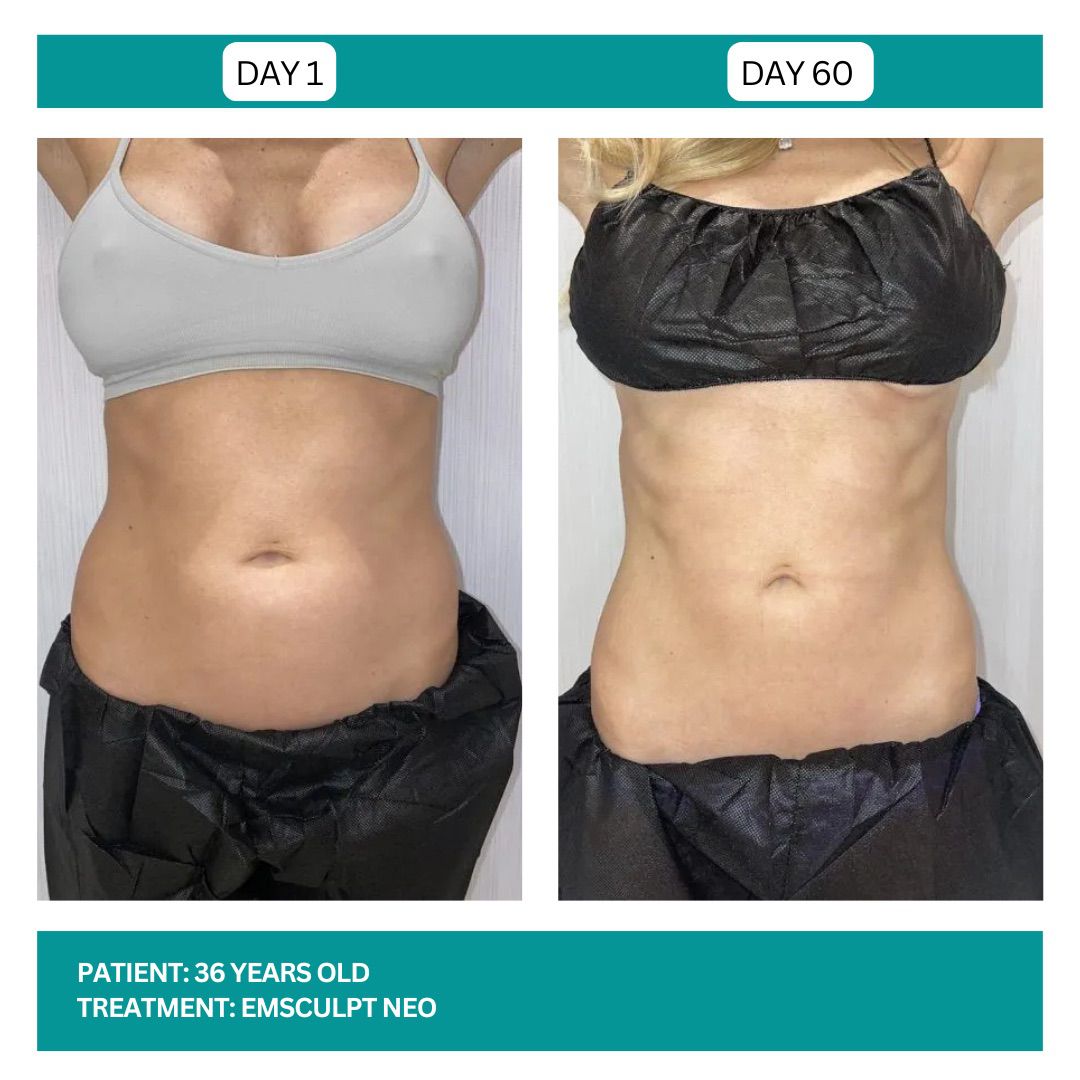 EMSCULPT NEO BEFORE AND AFTER - 3