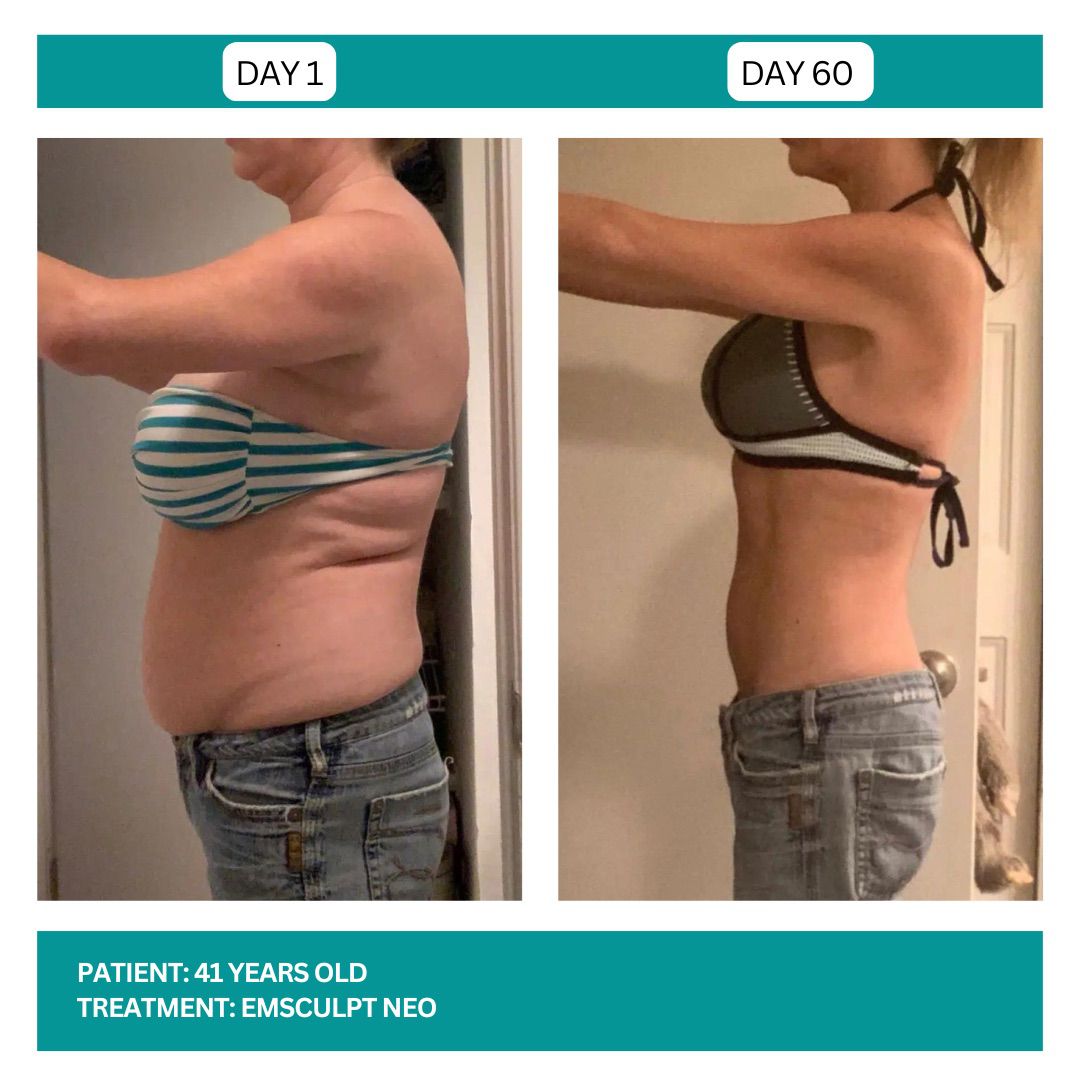 EMSCULPT NEO BEFORE AND AFTER - 1