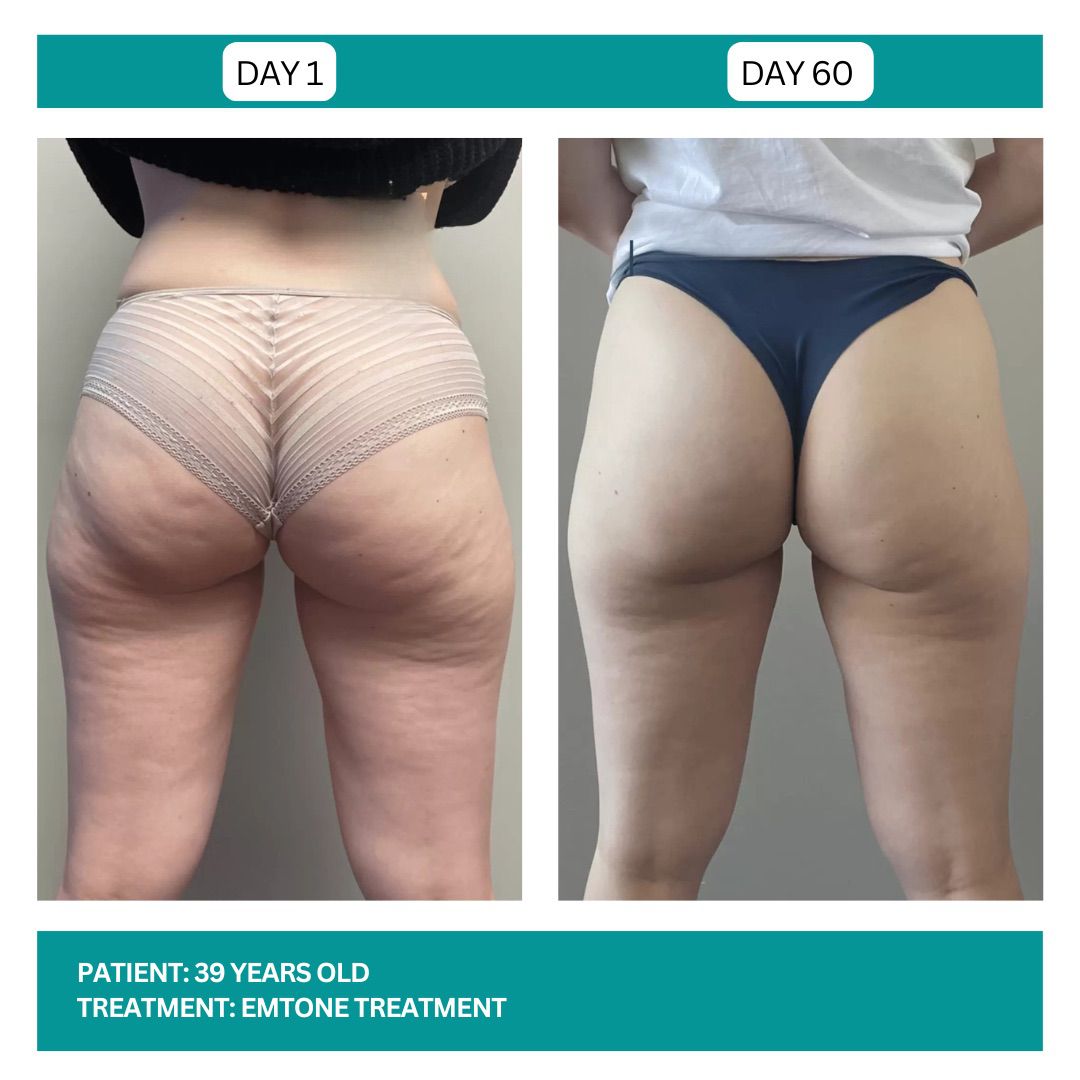 EMTONE BEFORE AND AFTER - 4