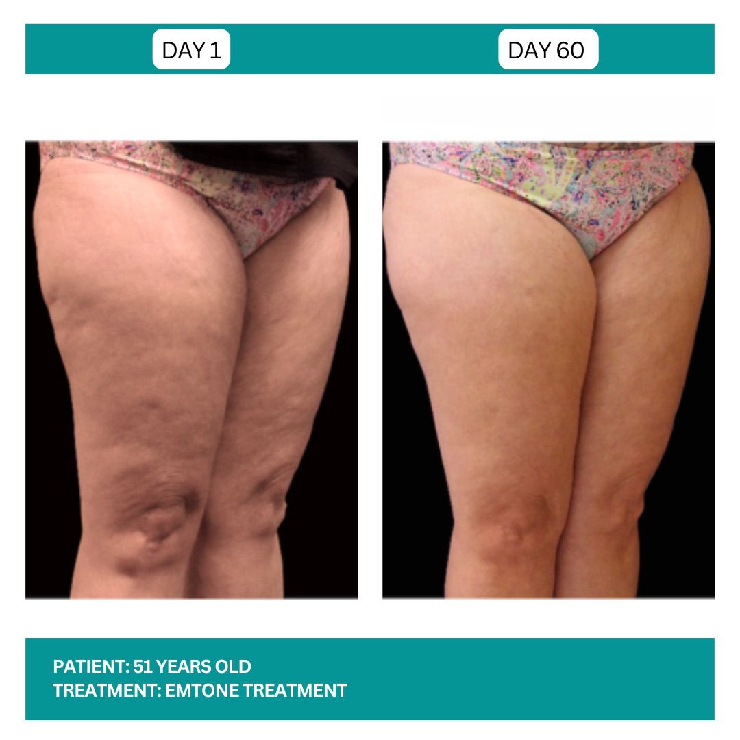 EMTONE BEFORE AND AFTER - 2