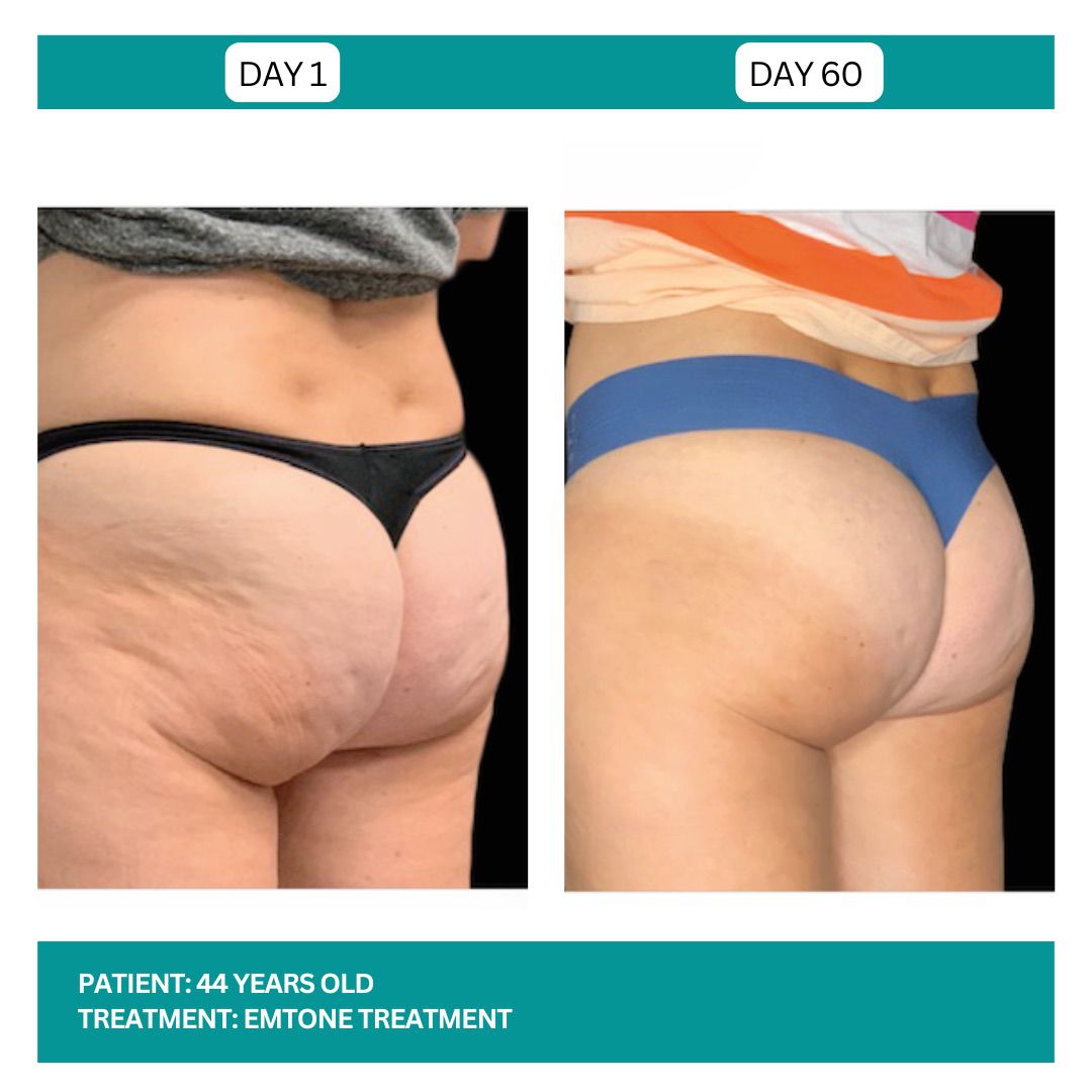 EMTONE BEFORE AND AFTER - 3