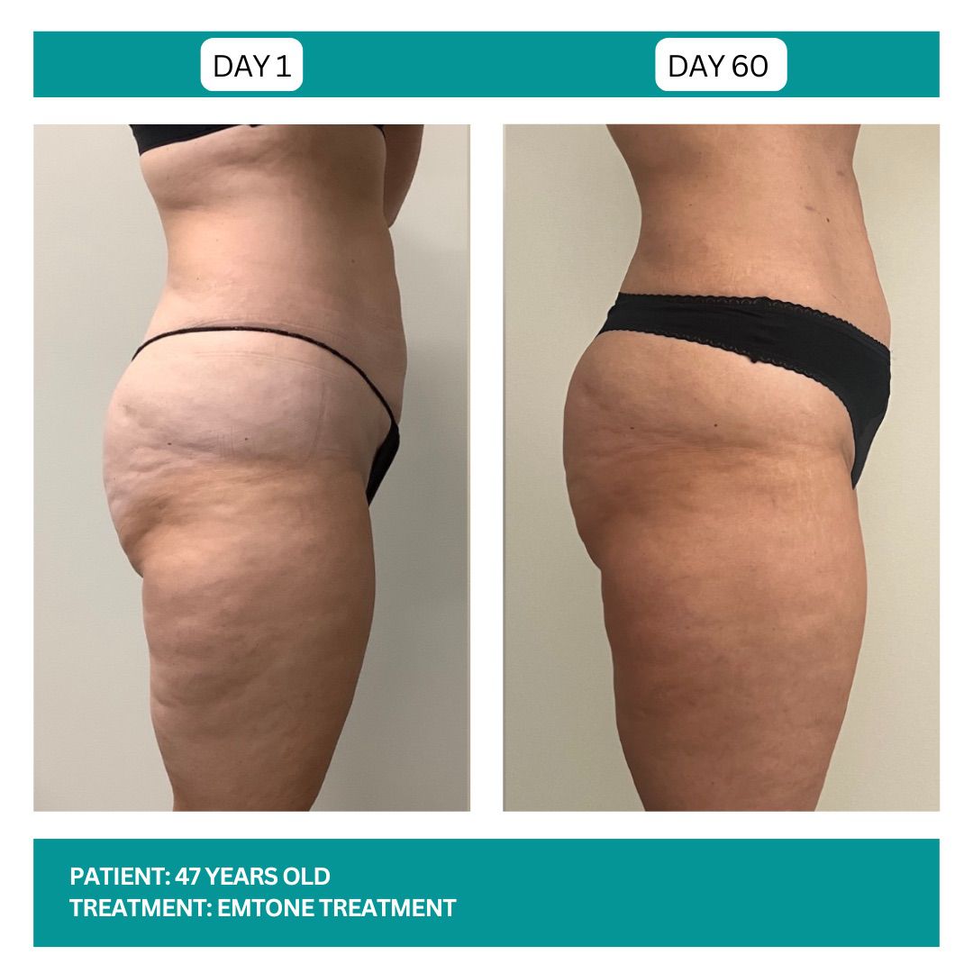 EMTONE BEFORE AND AFTER - 1