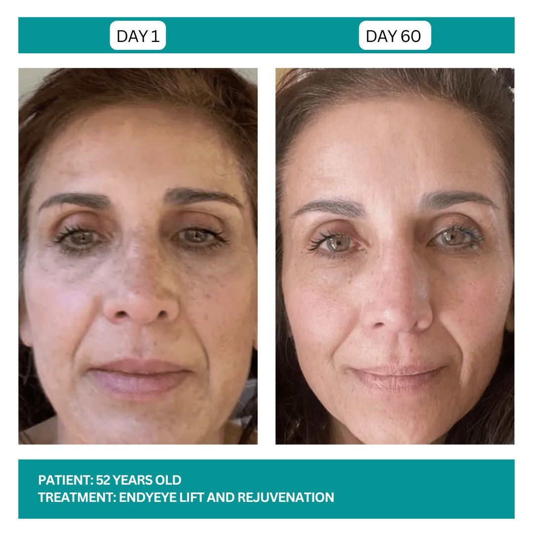 ENDYEYE TREATMENT - 4
