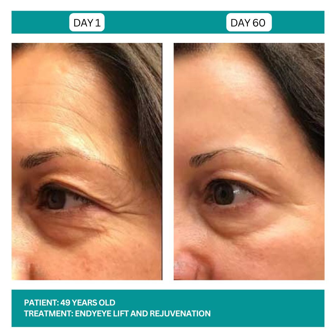 ENDYEYE TREATMENT - 5
