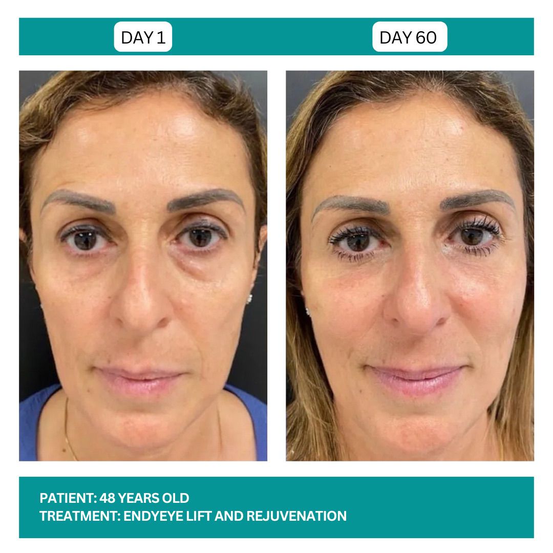 ENDYEYE TREATMENT - 2
