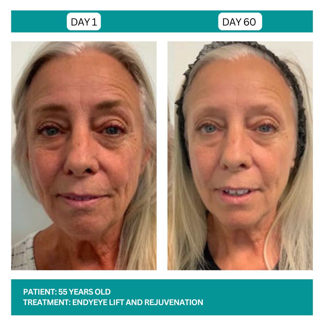 ENDYEYE TREATMENT - 3