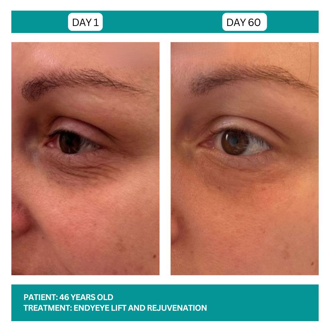 ENDYEYE TREATMENT - 1