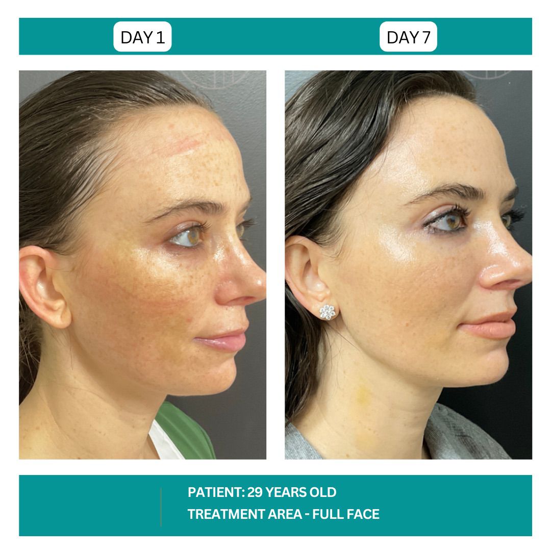STADIA HYDRAFACIAL BEFORE AND AFTER - 14