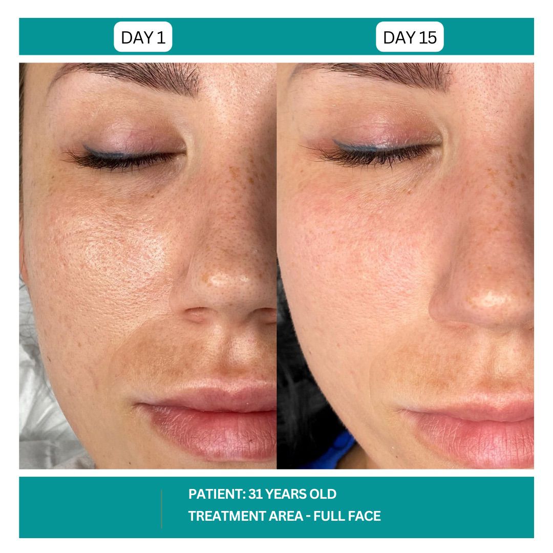STADIA HYDRAFACIAL BEFORE AND AFTER - 17