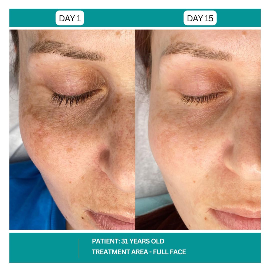 STADIA HYDRAFACIAL BEFORE AND AFTER - 16