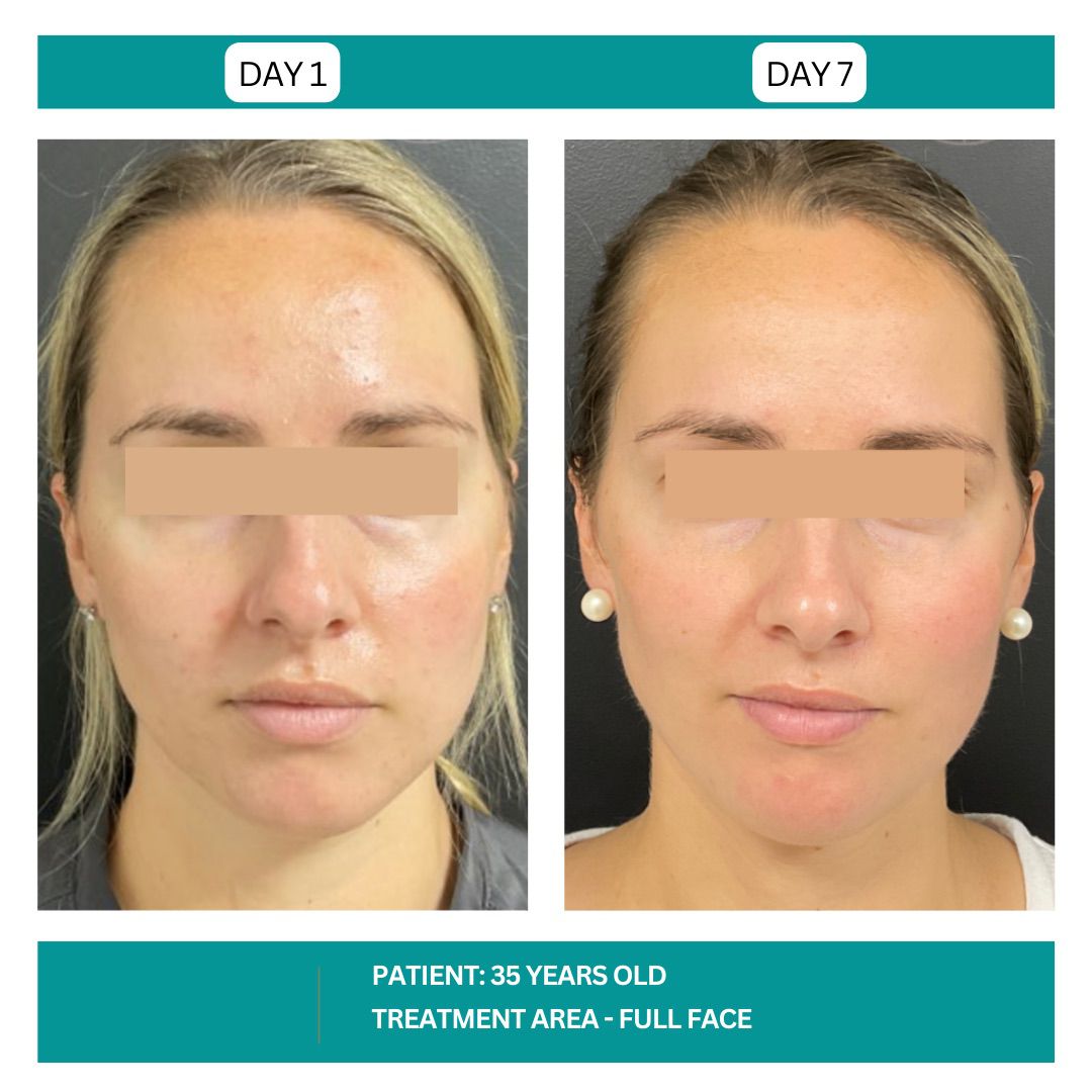 STADIA HYDRAFACIAL BEFORE AND AFTER - 13