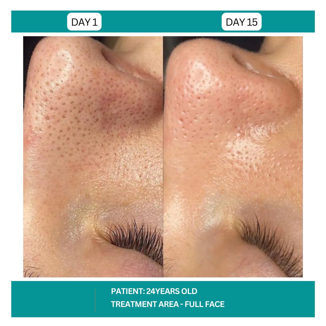 STADIA HYDRAFACIAL BEFORE AND AFTER - 18