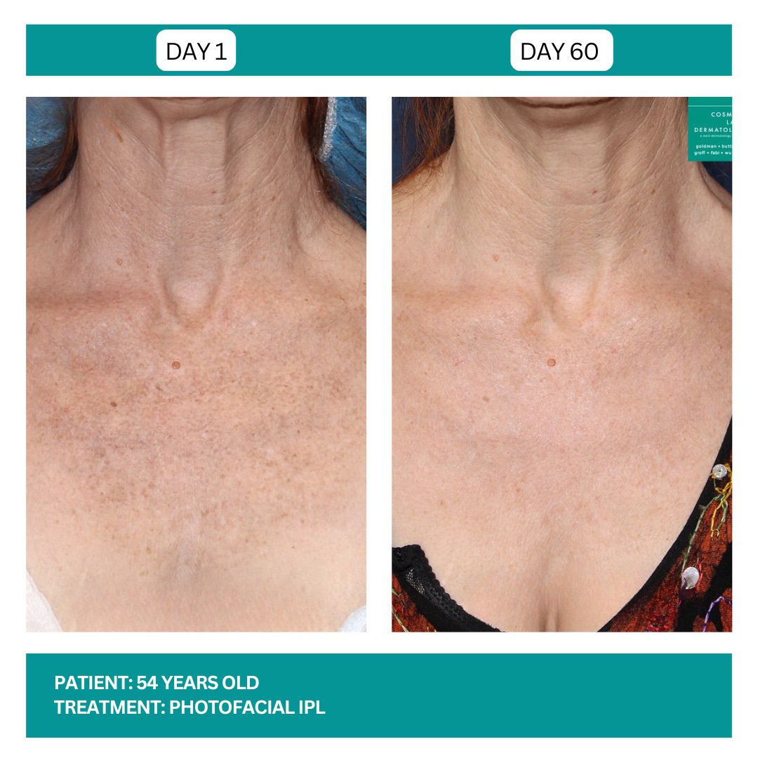PhotoFacial IPL Stadia 2025 - 4