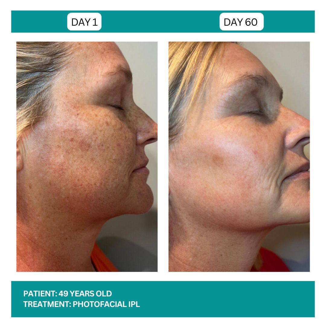 PhotoFacial IPL Stadia 2025 - 5