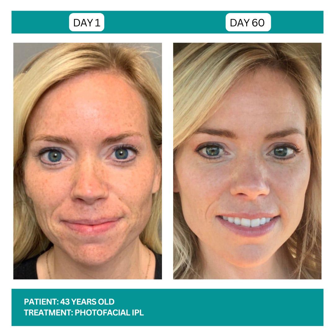 PhotoFacial IPL Stadia 2025 - 2