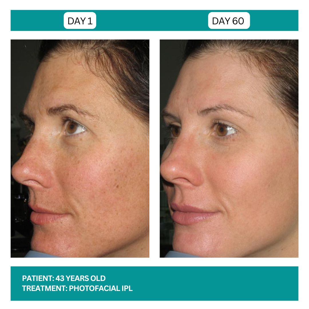 PhotoFacial IPL Stadia 2025 - 3