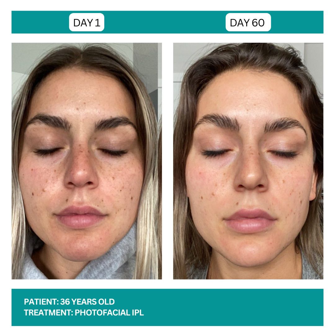 PhotoFacial IPL Stadia 2025 - 1