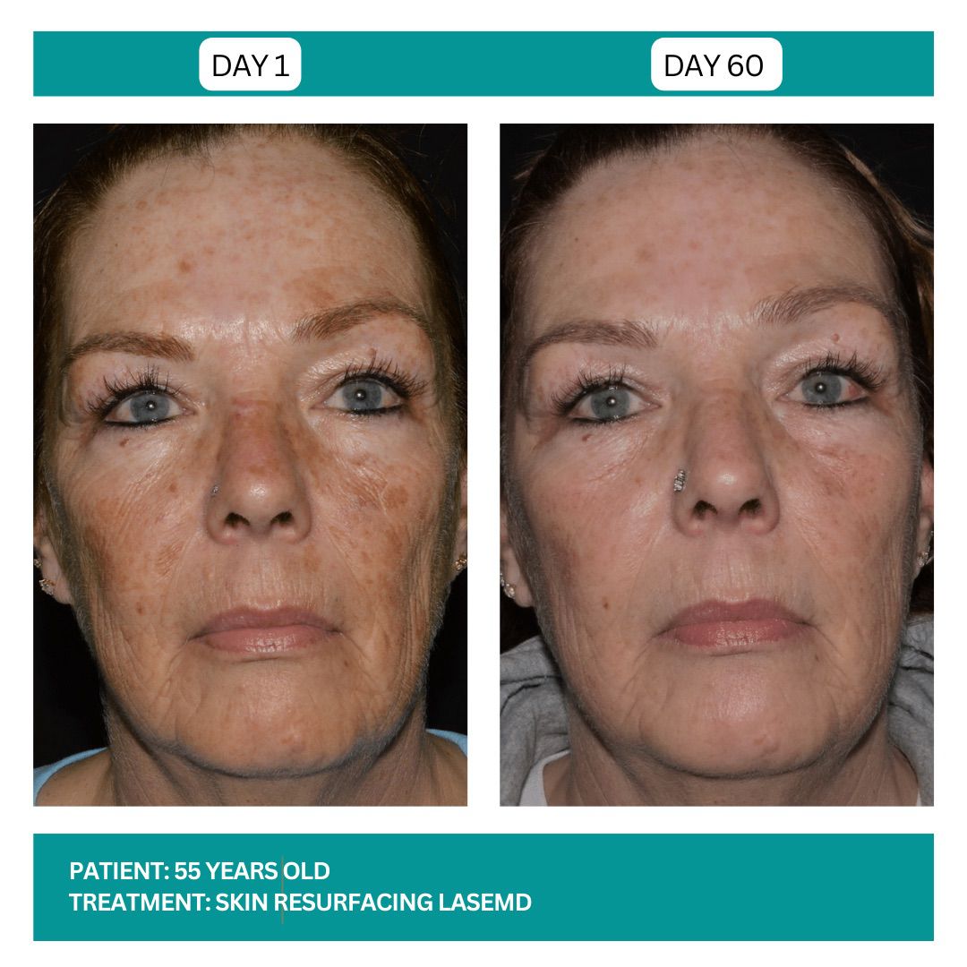 LASEMD STADIA BEFORE AND AFTERS - 4